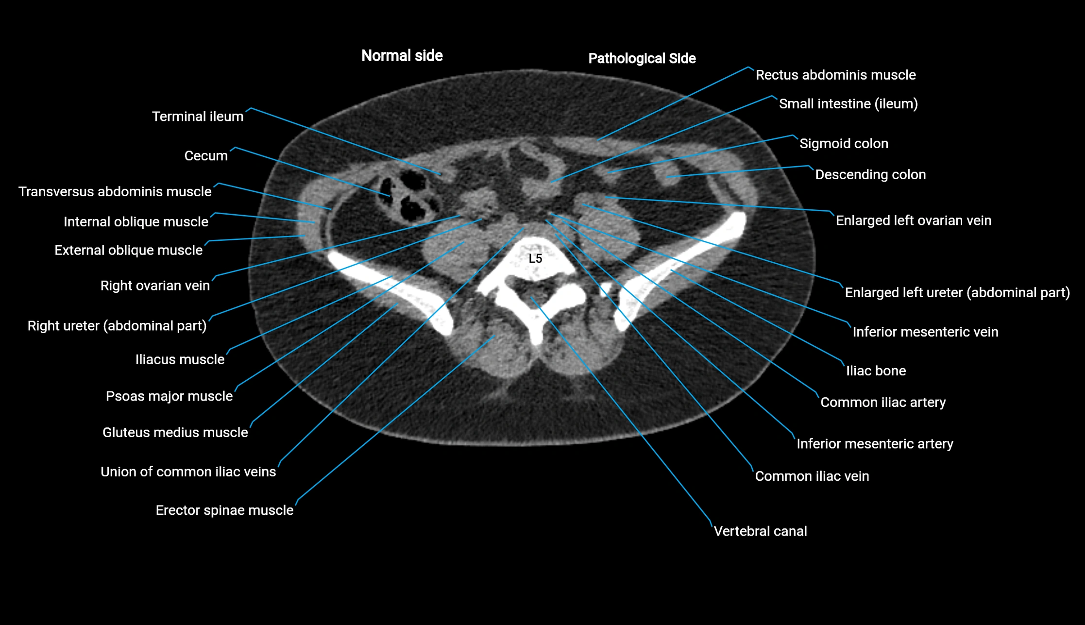 CT KUB axial cross sectional anatomy  radiology image -img-00201-00103.webp